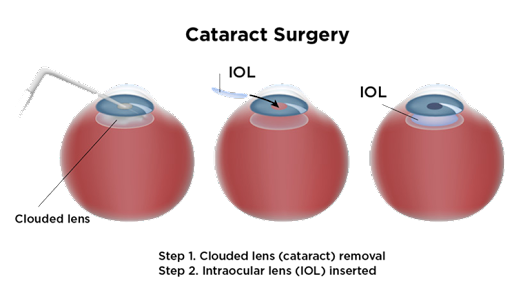 Cataract Surgery Steps Diagram